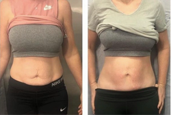 Ultrasound cavitation