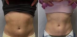 ultrasound cavitation
