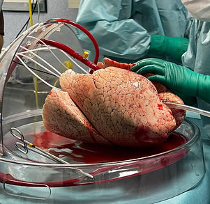 Human lungs on a clinical EVLP system