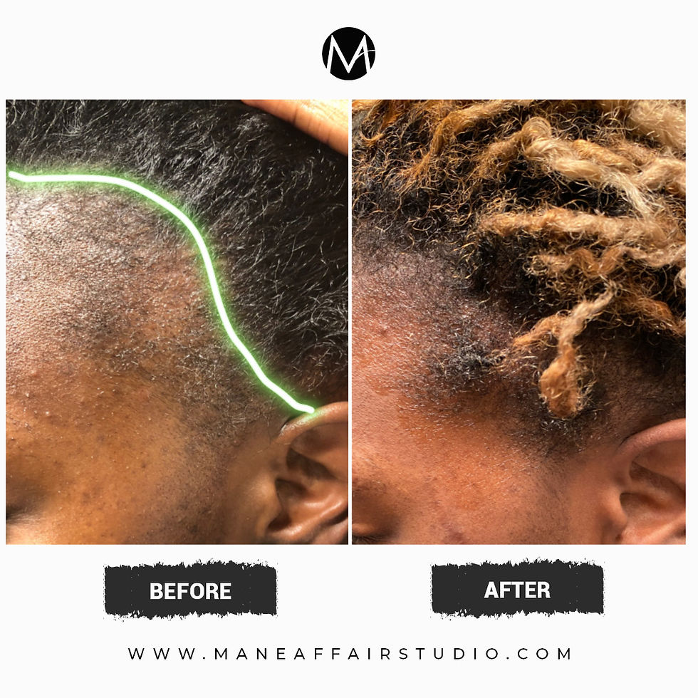 TRACTION ALOPECIA _ LEVEL I PROGRAM