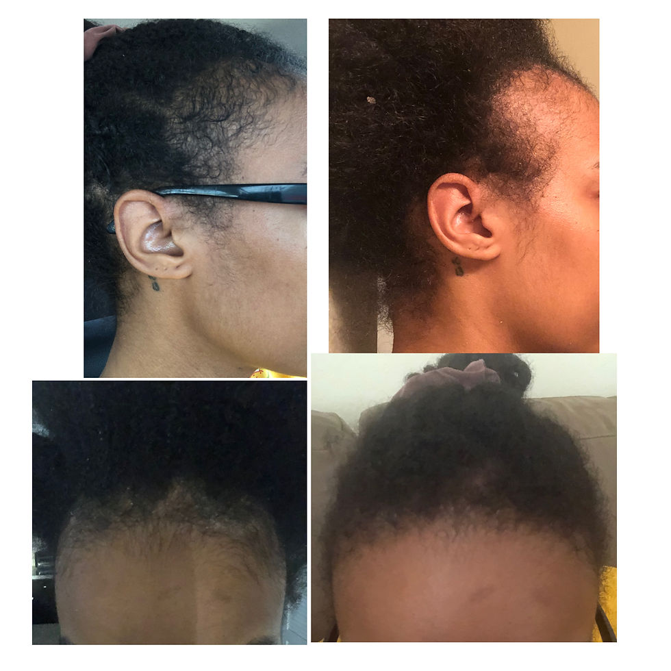 TRACTION ALOPECIA _ LEVEL I PROGRAM