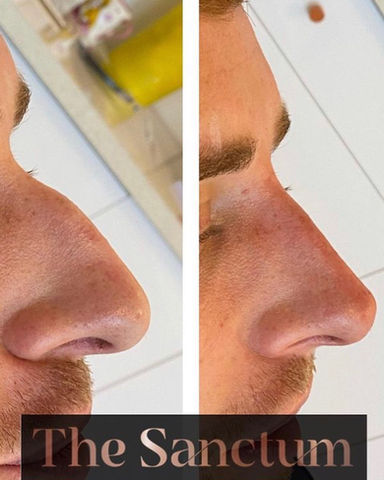 Non Surgical Nose Job Hull, Non Surgical Nose Job Cottingham, Non Surgical Nose Job East Yorkshire.