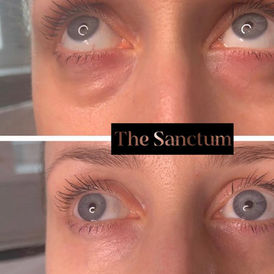 Tear Trough Filler Hull, Tear Trough Filler Cottingham, Tear Trough Filler East Yorkshire. 