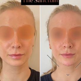 Chin Filler Hull, Chin Filler Cottingham, Chin Filler East Yorkshire.