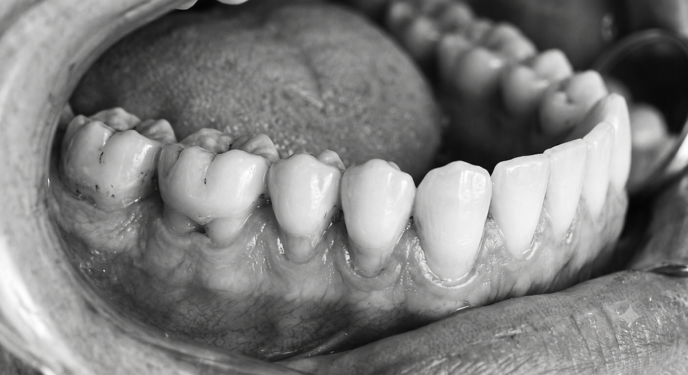 Black and white photo of a mouth on the lower right hand side with lip retracted, showcasing receding gums, exposing root surfaces on posterior teeth.