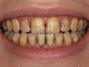 Close-up of a smiling mouth with heavily stained yellow teeth and brown discoloration on the enamel.