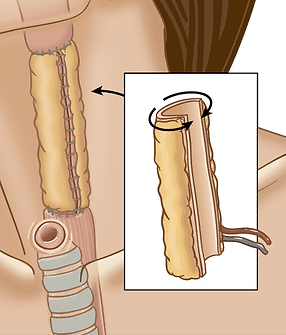 92-flap-recon-total-laryngopharyng-Artboard-1_2x.png