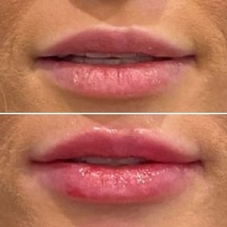 HF Lip Perk