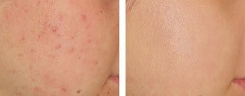 Pikkukuva: Kem trị mụn Pair Acne Lion Cream W 24g Của Nhật