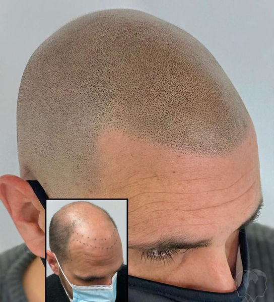 Man before and after treatment