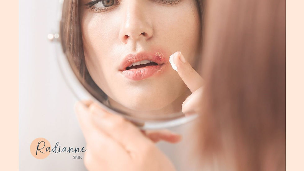 Can you get Lip Fillers if you have a history of cold sores?