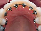LINGUAL BRACES cost ner you