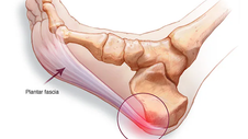 How Plantar Fasciitis Affects Movement and Function