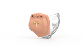 Intracanal.png