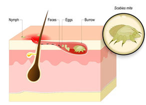 Uyuz musun? Scabies'e maruz kalınca (uyuz olunca) neler yapılmalı...