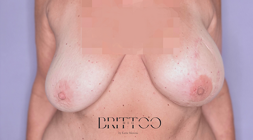 Brust nach abgeschlossener Brustwarzenrekonstruktion mit tätowierter Areola