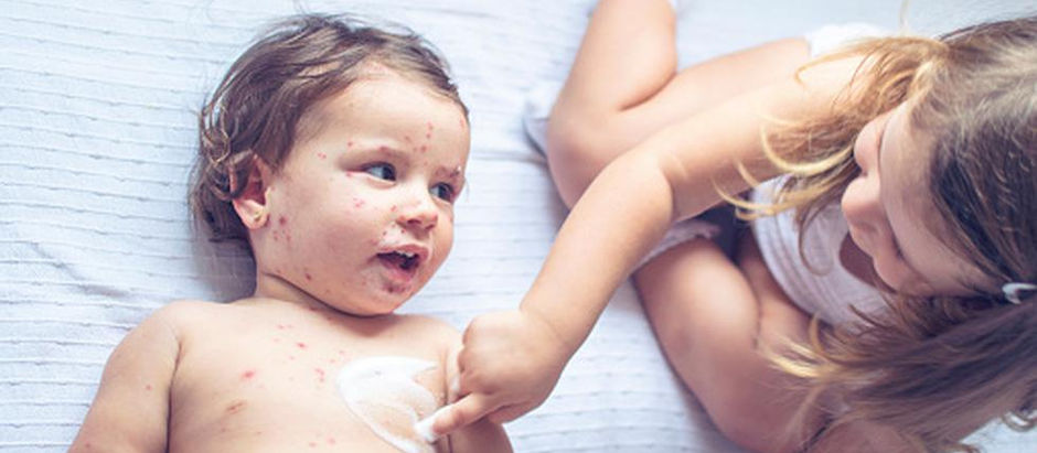 ¿Fiestas De La Varicela? Que Locura