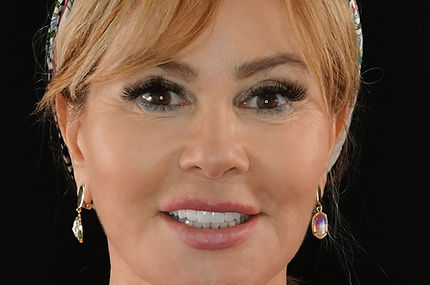 After Full Arch Dental Implants