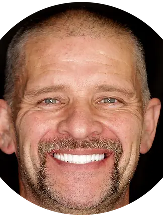 After ALL-ON-X Dental Implants