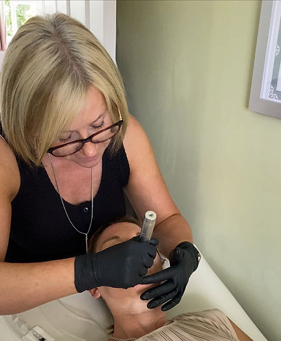 micro needling bromsgrove