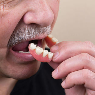 Protesi totale rimovibile in resina acrilica con denti estetici montati su modello, realizzata per riabilitazione funzionale ed estetica dell’arcata edentula.