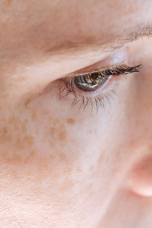 Skin Pigmentation