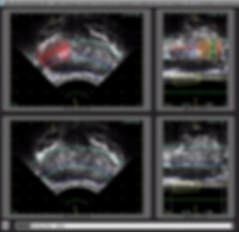 Sonablate Screenshot of Tissue Changes