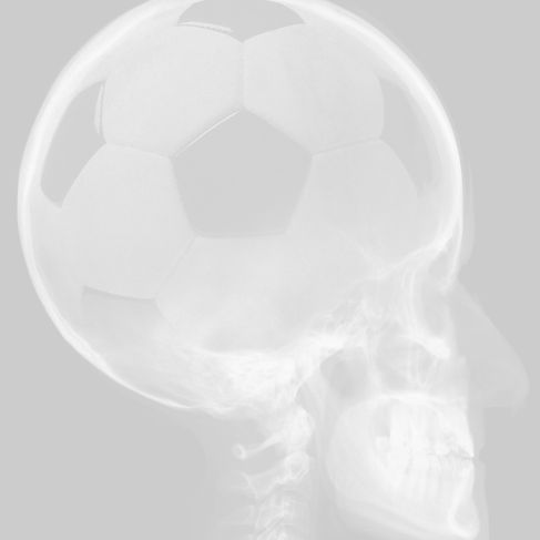 Radiografía de cráneo con balón de fútbol en