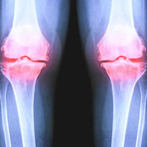 What is Genicular Artery Embolization or GAE?