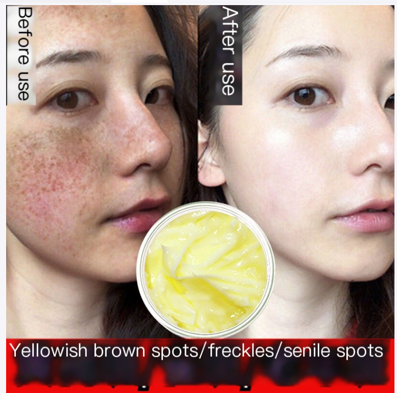 Herbal Astragalus Cream for Dark Spot Removal