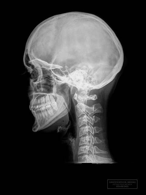 Leftside Skull And Neck X Ray