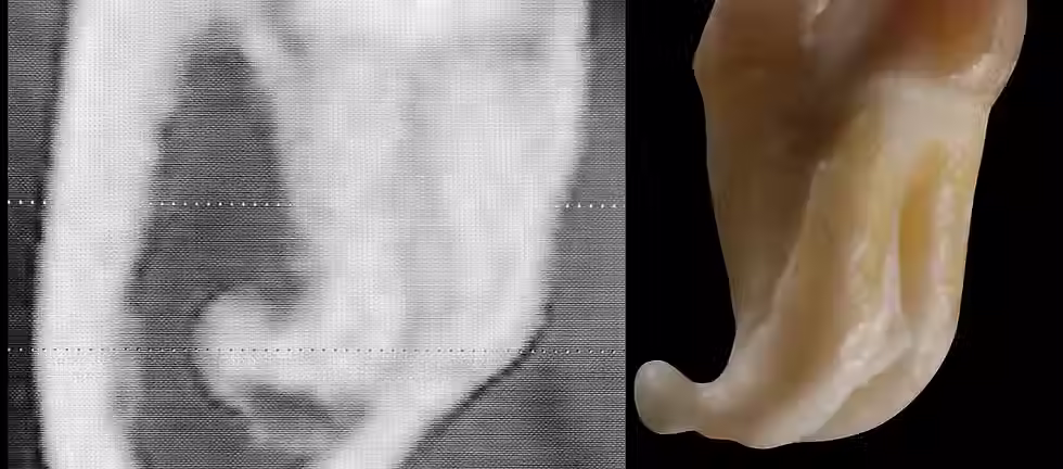 Estrazione del dente del giudizio - https___www.edilmya.com_