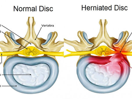 Are Herniated Discs Worse With Activity? | Separating Myth from Fact