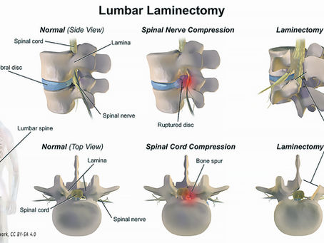 Laminectomy Risks vs Decompression a Safer Choice?