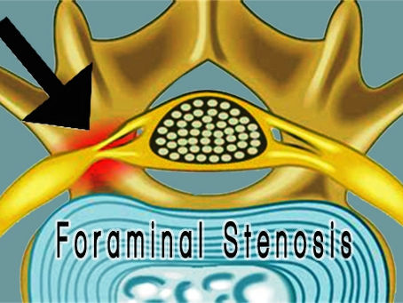 Non-Surgical Treatment for Formanal Stenosis
