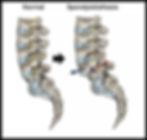 Diagram comparing a normal spine to spondylolisthesis, showing forward vertebral slippage relevant to spondylolisthesis treatment options