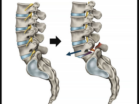 Spondylolisthesis Treatment Options: What Actually Helps When a Vertebra Slips