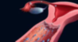 IUI.jpeg