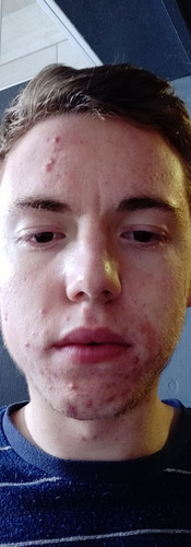 resultaat na de huidverbetering kuur