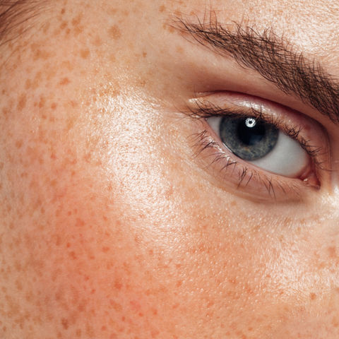 Dermaplaning in London