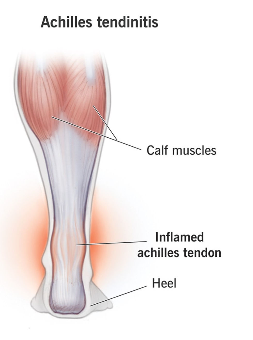 indicating where achilles tendonitis occurs