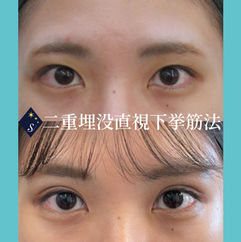 二重埋没直視下挙筋法