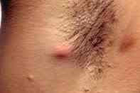 cyst armpit