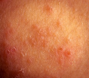 irritant contact dermatitis