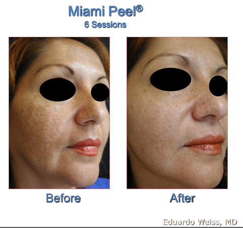 miami_peel_B_A_large.png