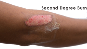 second-degree-burn