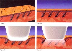 laser hair removal