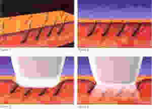 laser hair removal