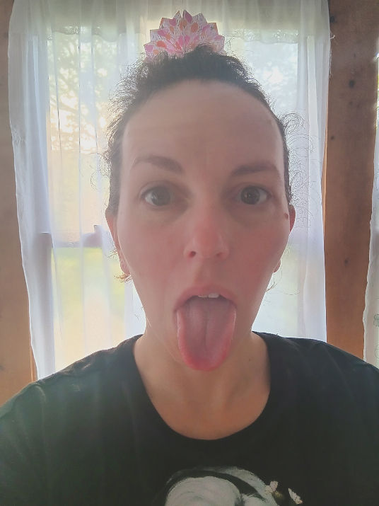 patient tongue more central day after first treatment for Bell's Palsy.