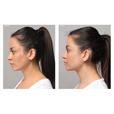 Thumbnail: Acne Advanced 3-Step Treatment System